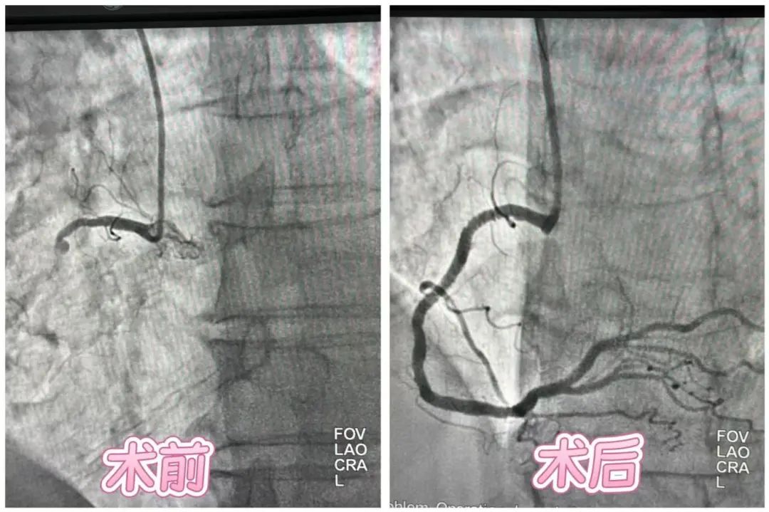 警惕心肌梗死，共同守护生命“心”通道